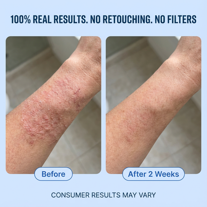 Eczema and Psoriasis Calming Cream