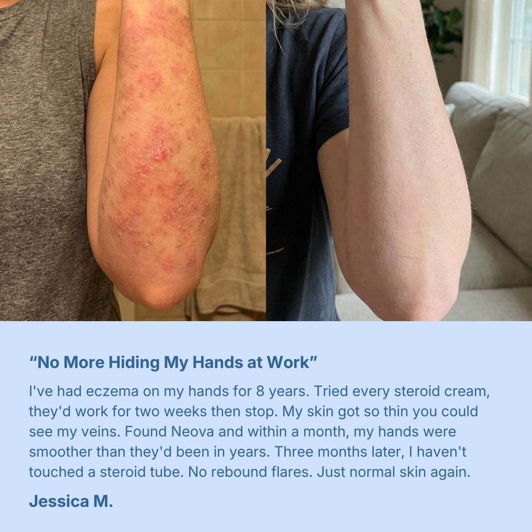 Eczema and Psoriasis Calming Cream