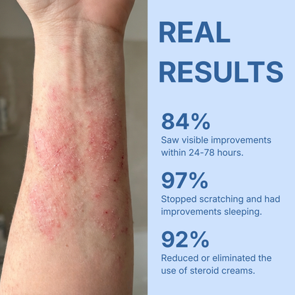 Eczema and Psoriasis Calming Cream